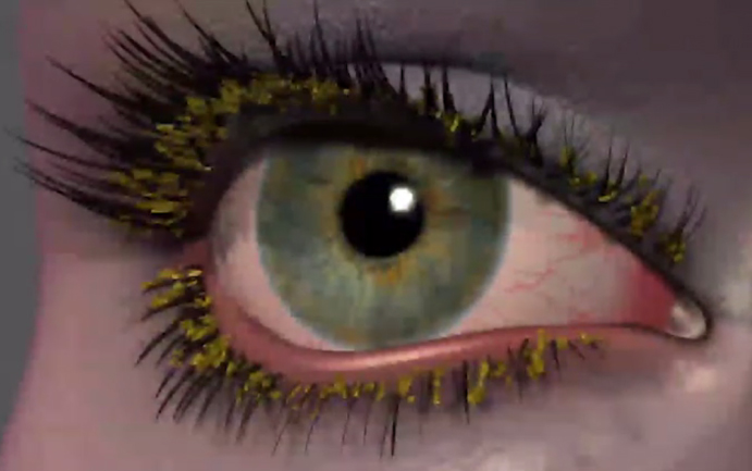 blepharitis eye